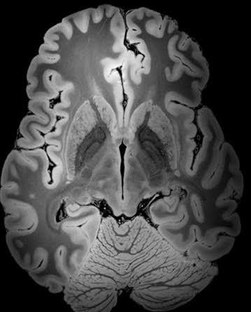 MildlyScrambled's tweet photo. Hurrah! Pancake Day.
Or, as I like to think of it, Edible MRI Day.
#MS #PancakeDay https://t.co/vbbScX9InE