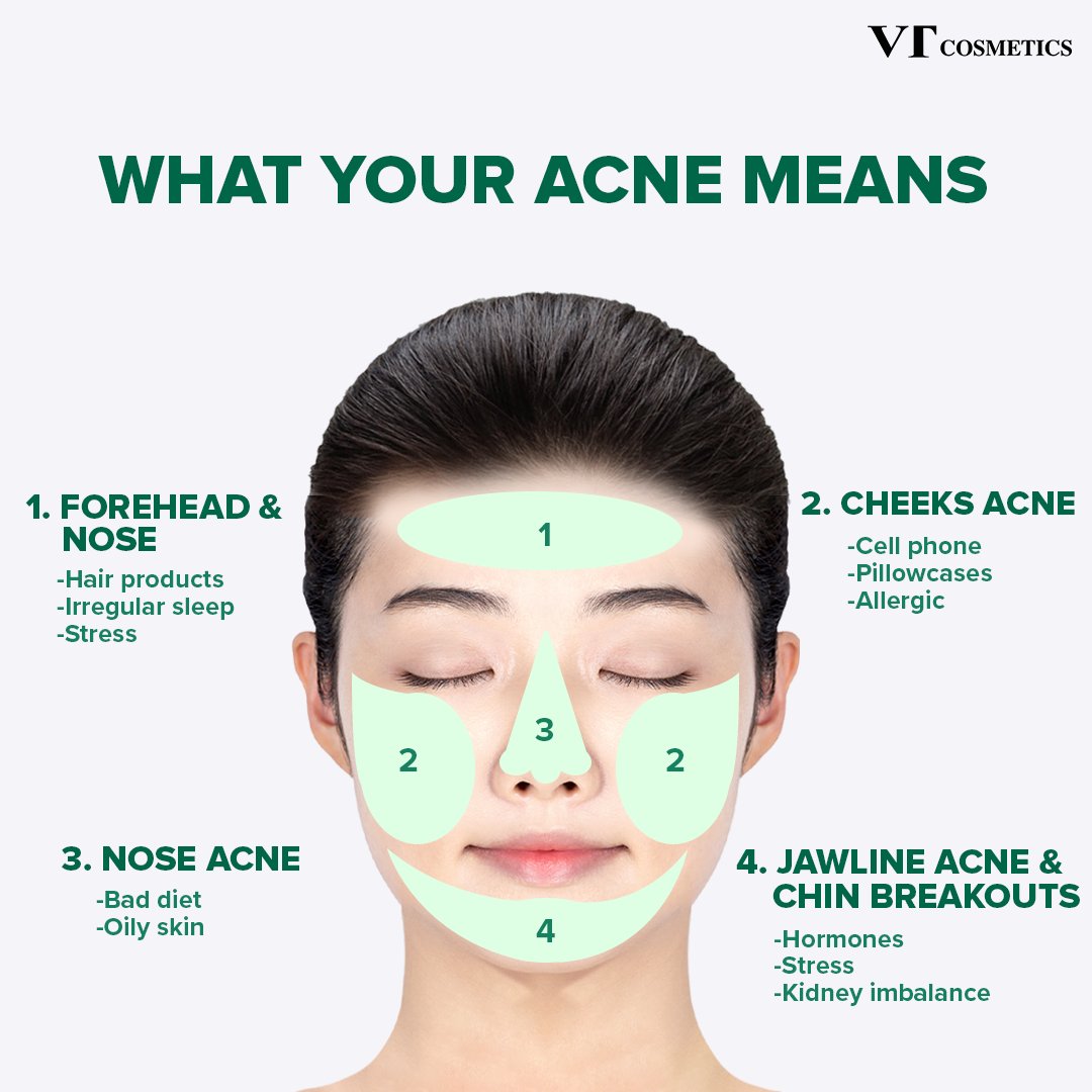Acne Face Map Men