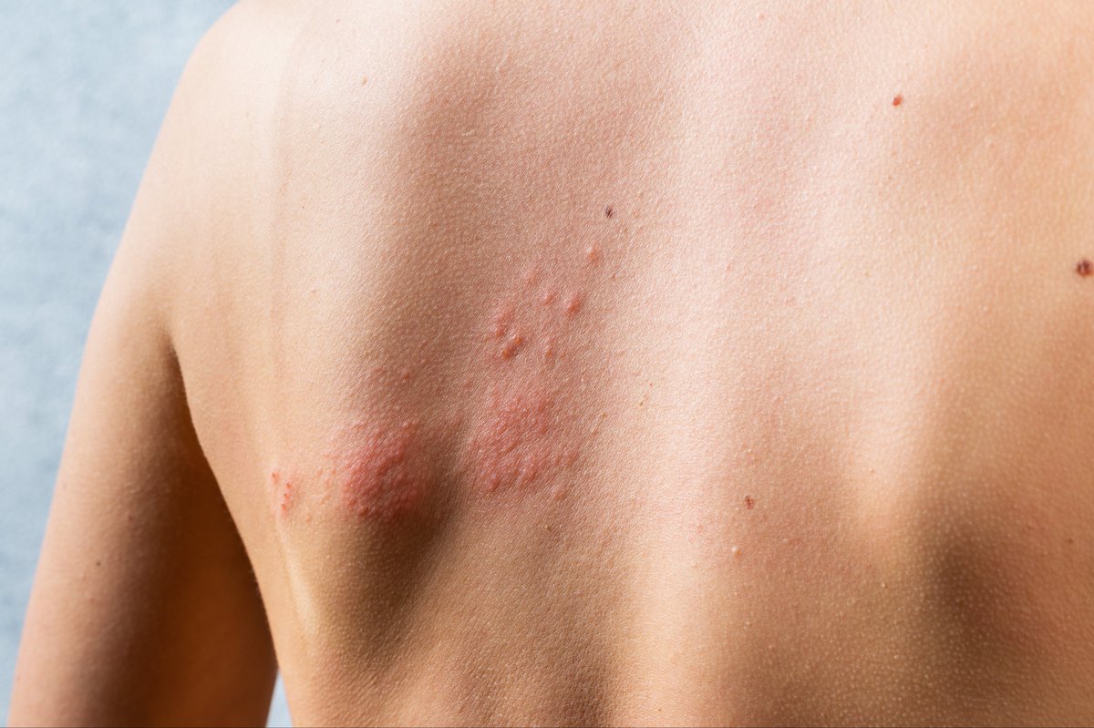 💉 Comenzamos a administrar una nueva vacuna contra el herpes zoster ➕ ow.ly/KIcz30sewA5 

También conocido como “culebrilla”, es una infección causada por el virus varicela-zóster y el riesgo de padecerla aumenta con la edad especialmente en situaciones de inmunodepresión