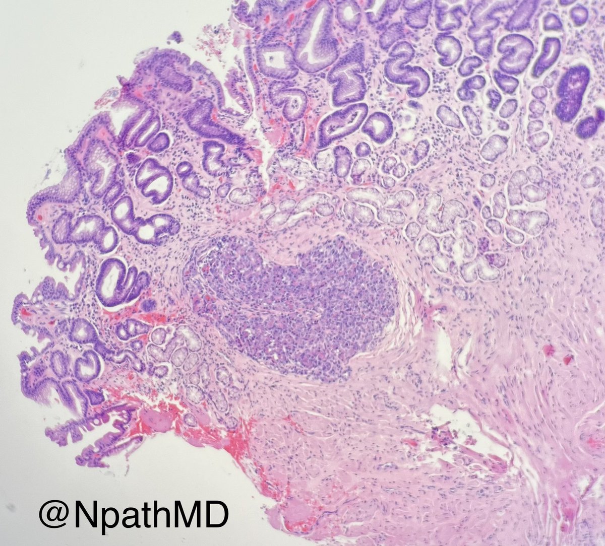 NPathmd's tweet photo. Antral lesion of 39 yo woman #pathologists #PathTwitter #GIpathology #Pathresidents https://t.co/bWPZIfAocd