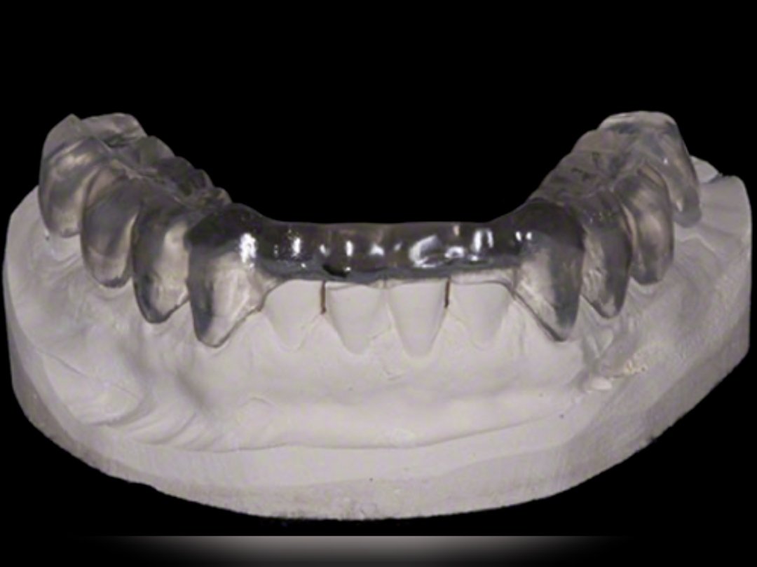 The first phase of TMD treatment is the orthopedic alignment and stabilization of the upper and lower arches. 

This is achieved with a Removable Orthotic, which is a custom-designed anatomical appliance that is worn 24/7 prior to any restorative dentistry. 

#dental