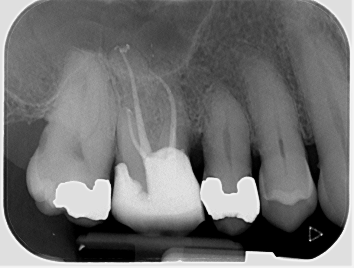 Here in Endoland its Deep Margin Management week! 🤣 in this case simple RCT UR6, core build up using Palodent sectional matrix and PTFE tape <a href="/DENTSPLY_UK/">Dentsply Sirona UK</a> @BetterEndo #savingteeth #endodontics