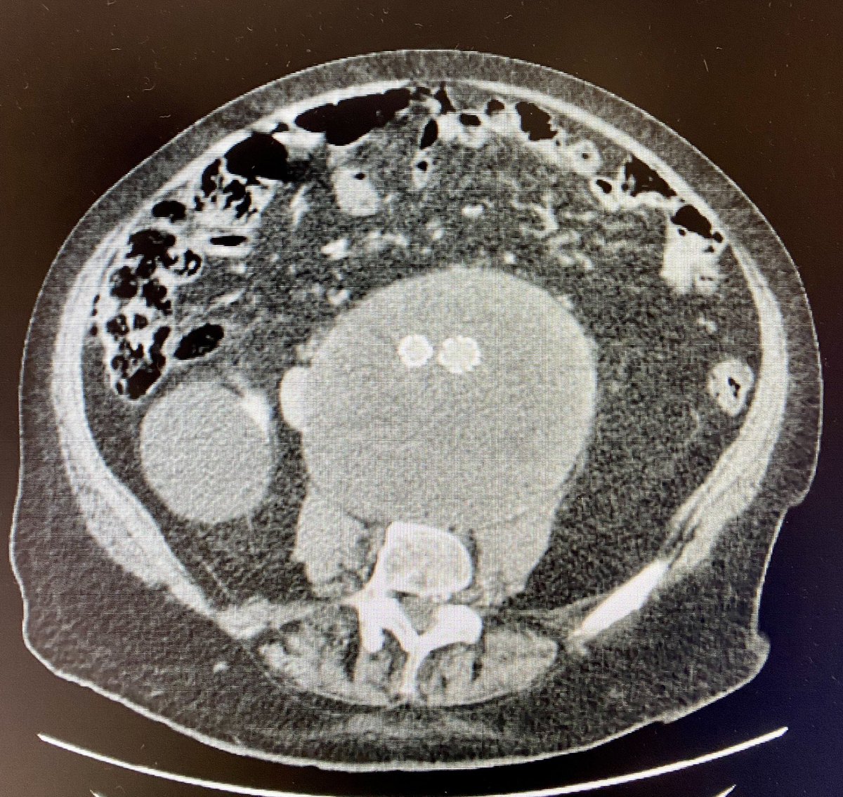 New horizons in vascular and endovascular surgery. Second explantation in one month. AAA EVAR  in 2014, 67 mm, iterative endo leaks procedures 2015, 16, 17, 19, 20, 21. Today 84 yo. Diameter 151 mm. #aortaed #vascsurg #vasctwitter #inthebucket