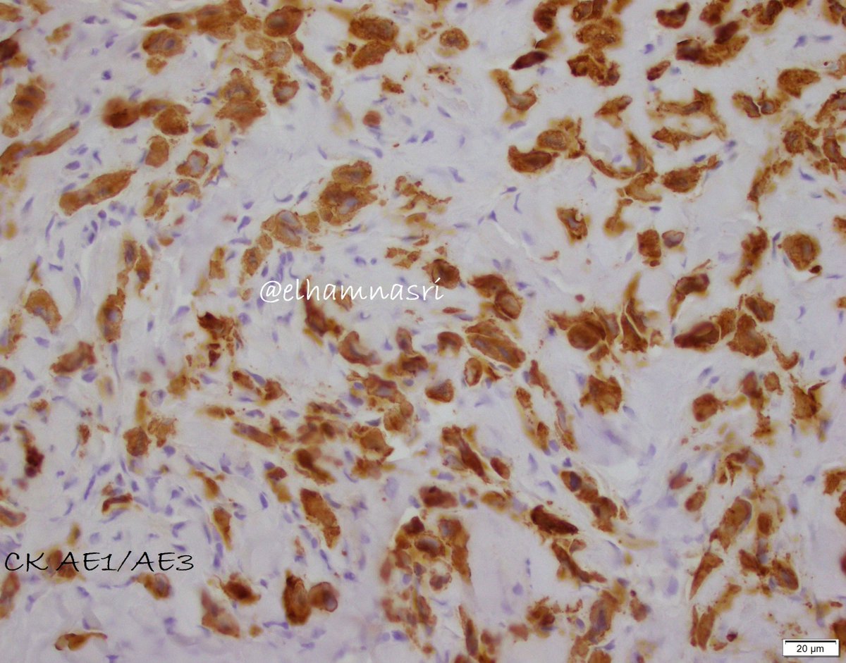 Young male patient with a slowly growing mass of small finger of the hand- Beware of the "granulomatous-like lesions," sneaky sarcomas might be hiding there!!
#BSTpath #PathTwitter