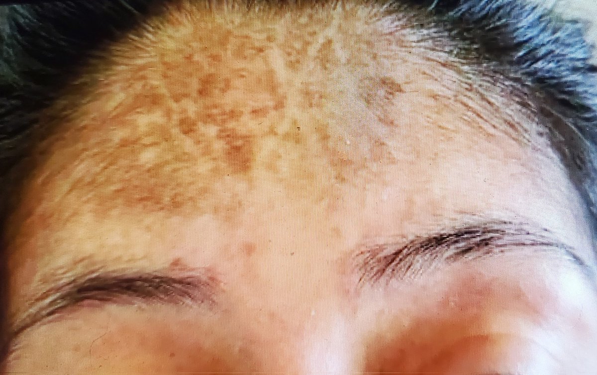 ConsejosReumato's tweet photo. La #Piel se compromete en diversas enfermedades reumatológicas sistémicas, en la foto vemos #discromía en la frente de una mujer con #esclerosissistémicaprogresiva o #esclerodermia . #PSS #esp #Skin #scleroderma #FACE #systemicsclerosis #escleroderma https://t.co/DnlCKOmNRI