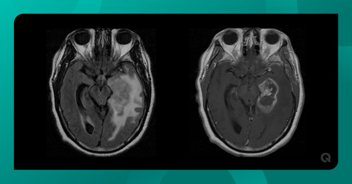 QMENTA_Inc's tweet photo. Can you identify the type of tumor in this #BrainImage? ๐ค
Let us know in the comments!
#Neuroimaging #MedicalImaging #Radiology https://t.co/qwlpRamDUy