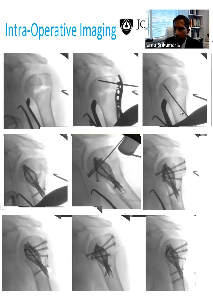 drhiteshg's tweet photo. https://t.co/9JrVKtSKyO

Proximal Humerus #Fractures

#orthotwitter #orthopaedicprinciples #frcsortho #iases https://t.co/M67Qggisco
