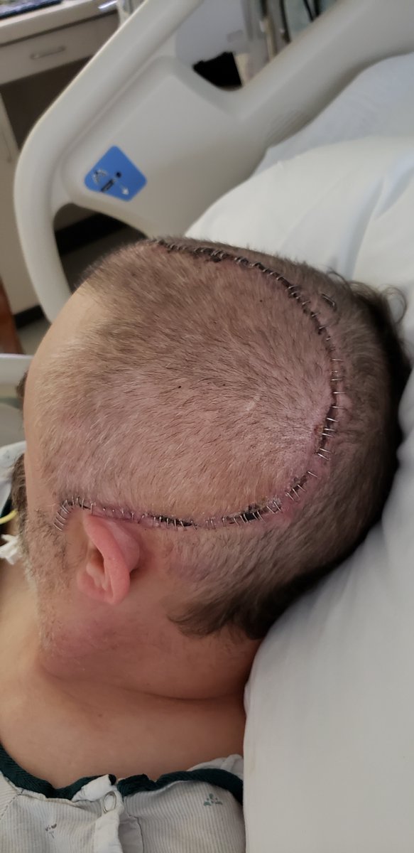 Lingraphica's tweet photo. Meet Bruce! He acquired #aphasia thru a traumatic brain injury #TBI He was riding his bike, flew off &amp; injured his head. He was given a <10% survival rate &amp; proved them wrong! Bruce loves music &amp; plays in 6 bands. He can't wait to share his story! #AphasiaAwareness #docuseries https://t.co/dZ4NUWHKCv