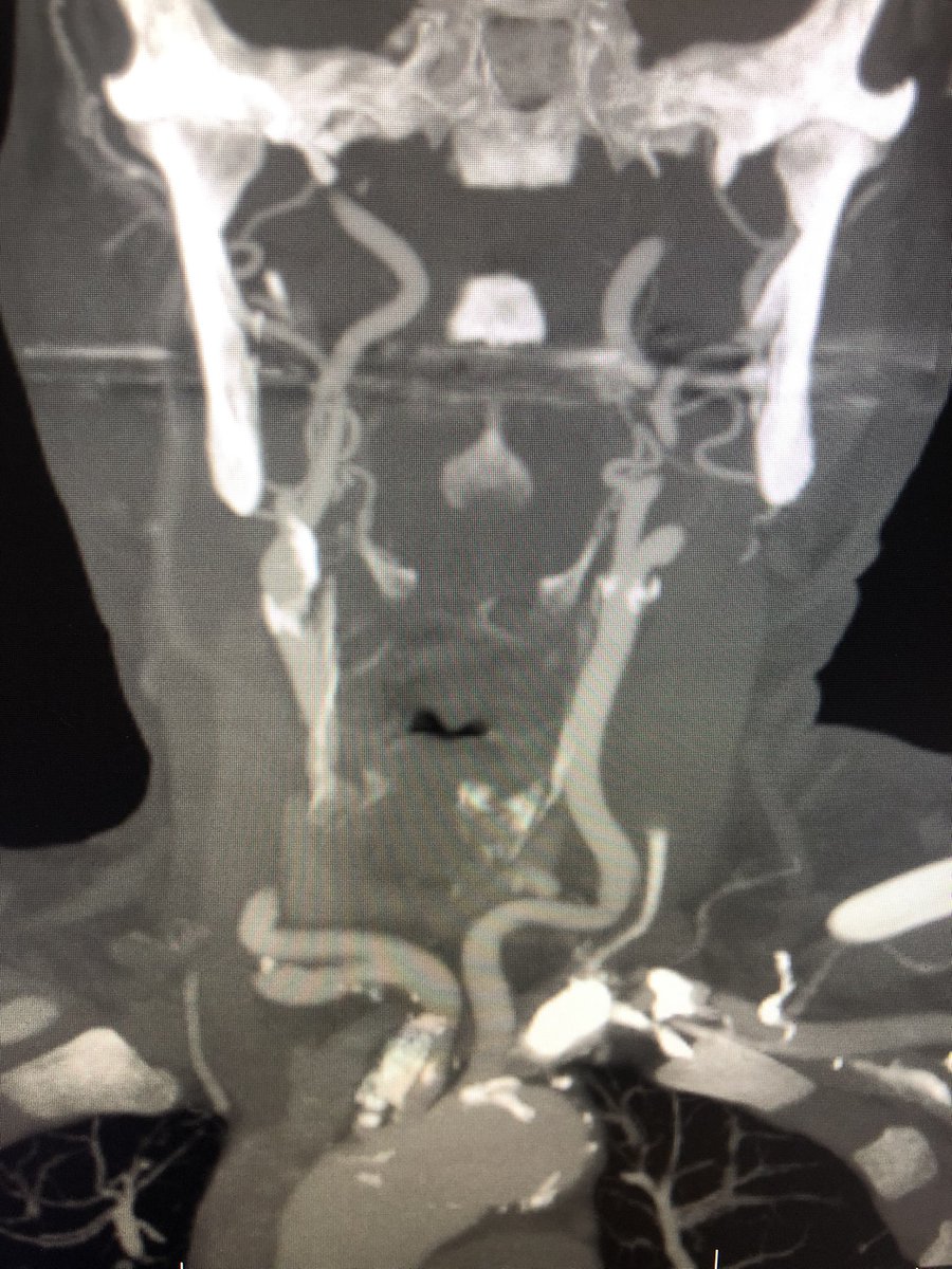 JEFFAortic's tweet photo. 74 yo patient with remote hx of vision changes/stroke found to have Inominate occlusion. Underwent successful ascending aorta/right carotid and subclavian bypass via mini sternotomy by Dr. Dinos Plestis and Dr. Michael Nooromid @AorticSurgeonMD @mnooromid @DrBabakAbai @pdimuziomd https://t.co/oucoLN2YnA