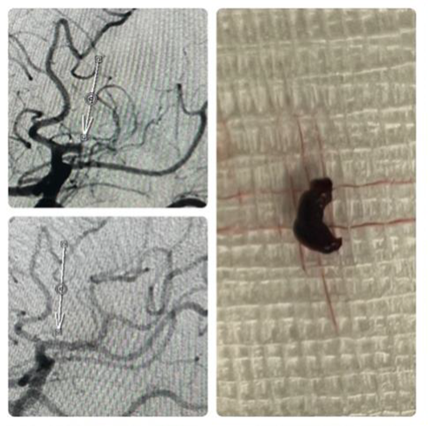 PenNeuro's tweet image. US HCPs: #RED62 case by Dr. Mikayel Grigoryan (@LABrainPlumber) out of Glendale Adventist Medical
Center. #REDGlideDifference Rx only. For risk info: bit.ly/37YcYIU Clinical results may vary.