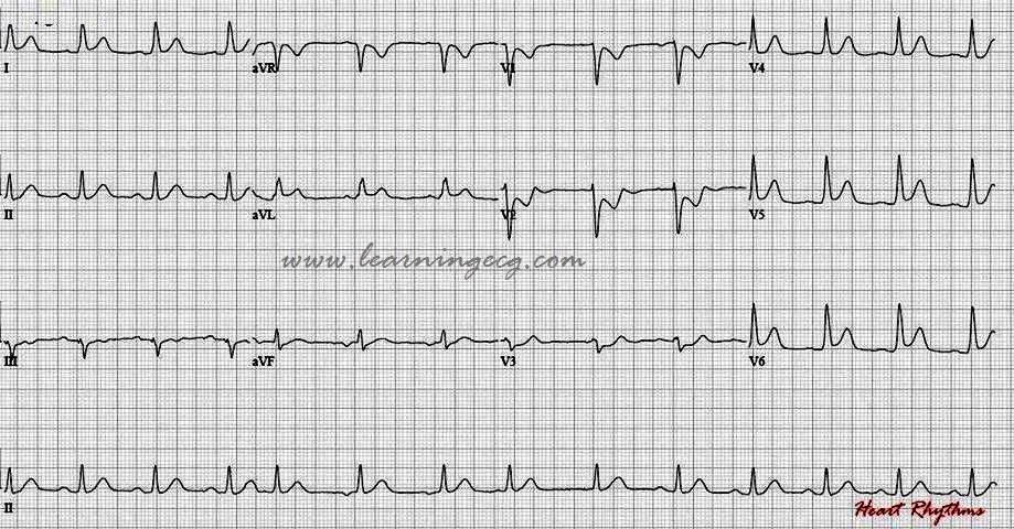 From the archives

Elderly with h/o HTN & dyslipidemia c/o chest pain.
What is your interpretation?
If you cannot get this, Dr @smithECGBlog  will be mad. 🙂

goo.gl/cQHv5q

#FOAMed 
#meded 
#cardiotweeter