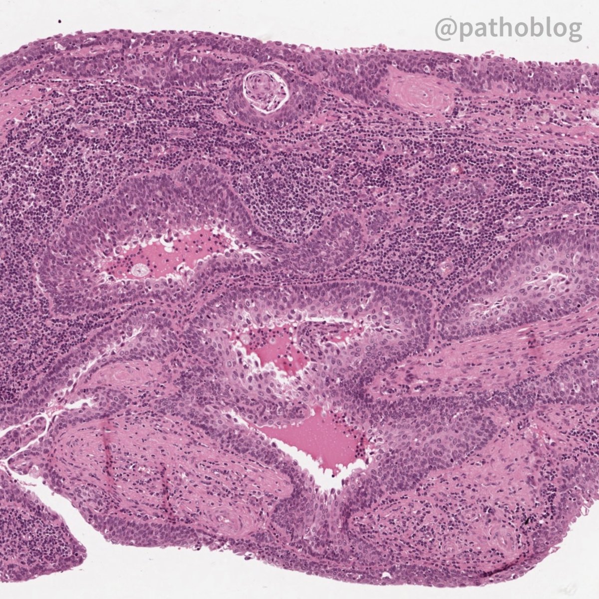 pathoblog's tweet photo. Hello, dear #pathtwitter! I present to you an interesting case: male, 49 y. o., mass in the neck area. The clinical diagnosis is a tumor of the parotid salivary gland. Did you recognize it?
โ
#pathoblog #pathology #ENTpath https://t.co/8pojPFzJCf