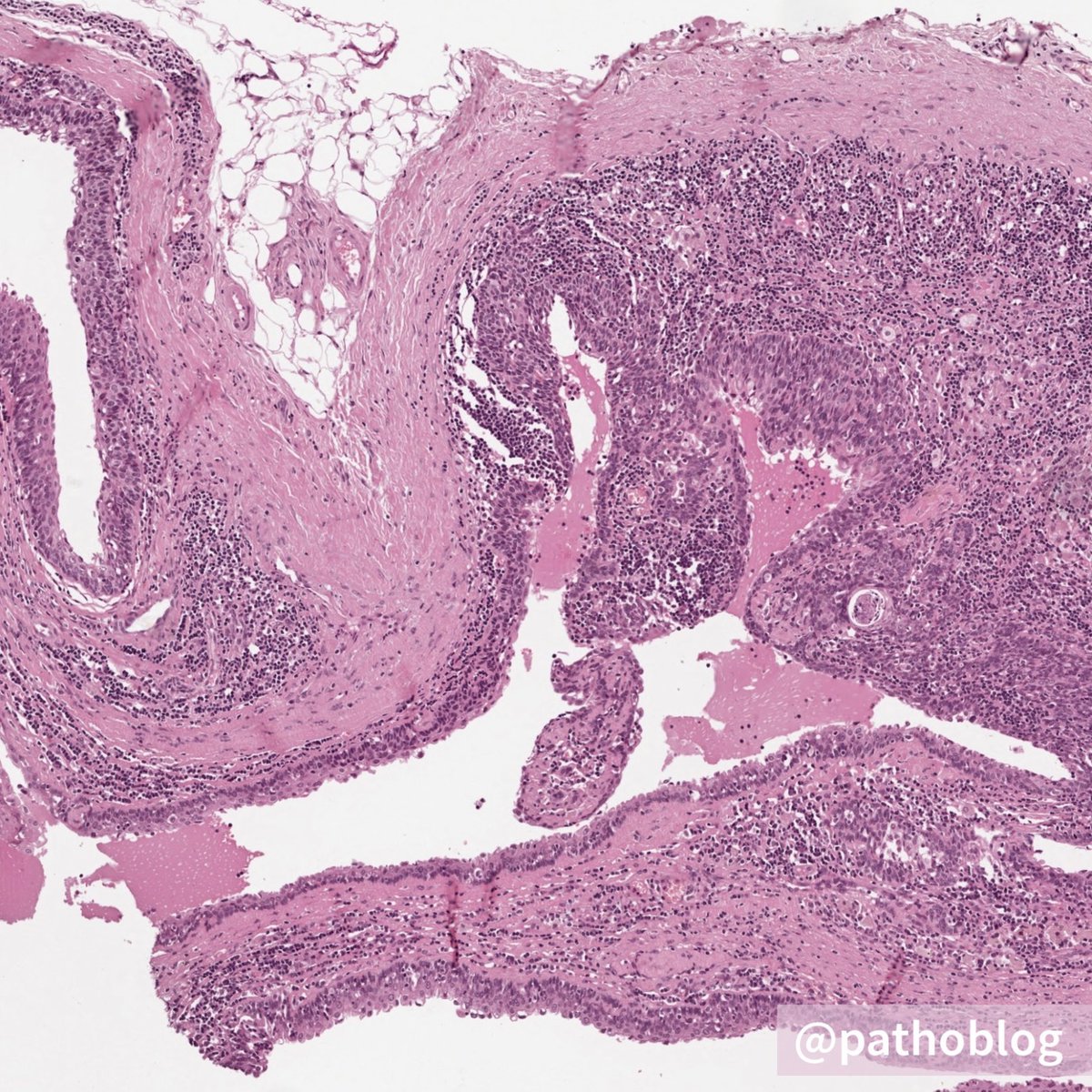 pathoblog's tweet photo. Hello, dear #pathtwitter! I present to you an interesting case: male, 49 y. o., mass in the neck area. The clinical diagnosis is a tumor of the parotid salivary gland. Did you recognize it?
โ
#pathoblog #pathology #ENTpath https://t.co/8pojPFzJCf