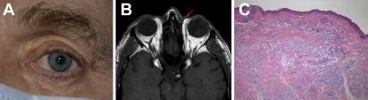 AAOjournal's tweet photo. Residual oil from hydraulic fluid trauma presenting as discrete periorbital foreign bodies https://t.co/HxoxfqwlsT https://t.co/b7Z7ppAFkH