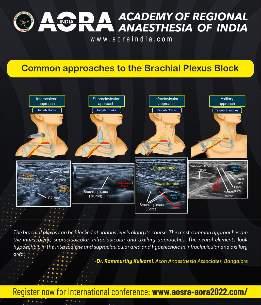 AoraIndia's tweet photo. The brachial plexus can be blocked at various levels along its course. The most common approaches are the interscalene, supraclavicular, infraclavicular and axillary approaches. https://t.co/vYfH6qzn0E