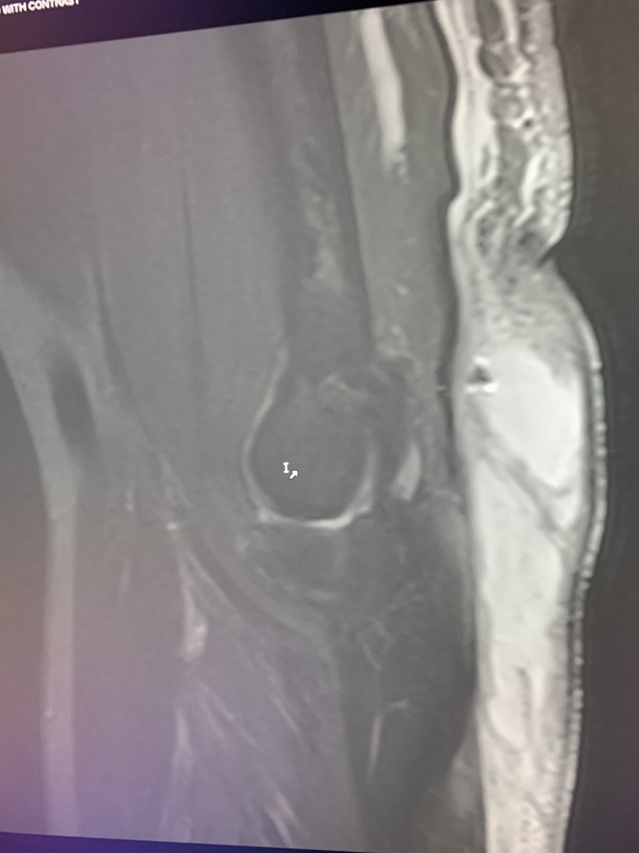 northwoods1980's tweet image. Started out as a minor olecranon bursitis but then someone decided to stick a needle in it and inject steroid early on. Now it’s turned into a monster cellulitis, expansion of bursitis and trying to form an abscess.