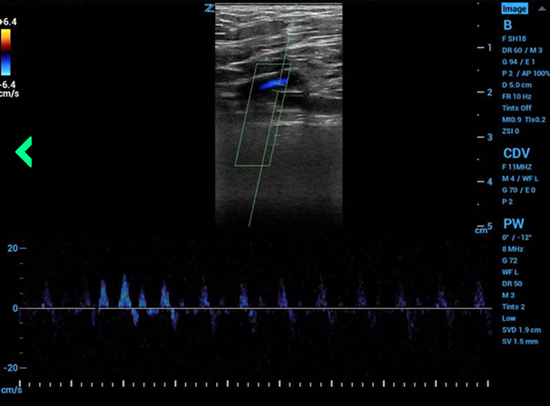 JStowens's tweet photo. Femoral artery PW doppler during pulse check and CPR. 
 Is this ROSC? Normal peak velocity is >100cm / sec, here only 10cm/s.  BP is cycling...will it change your mind? Continue chest compressions? What REALLY is PEA? #POCUS #Emergencymedicine #EMPOCUS https://t.co/iyjvh46eSH