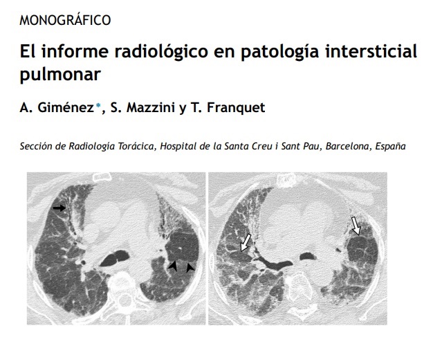¿No te cuesta mucho describir los hallazgos en la enfermedad intersticial pulmonar? 
En este #ArtículoRecomendadoDelLunes 🕵️‍♀️ os traemos una guía para elaborar un informe estructurado con la terminología más adecuada

➡️elsevier.es/es-revista-rad…
<a href="/RevistaRADIOLO2/">@RevistaRADIOLOGIA</a> <a href="/SEICAT_RAD/">SEICAT</a>
