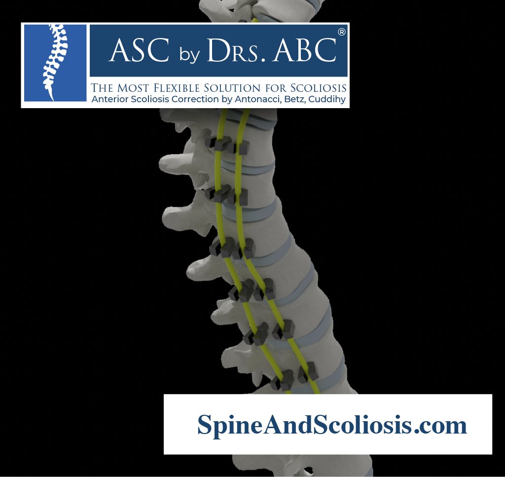 DarrylAntonacci's tweet photo. Treatment of Patients with Scoliosis Using a Unique Anterior Scoliosis Correction Technique

Medical Research Archives, Volume 9, Issue 7, July 2021

https://t.co/23A13514UW

#Scoliosis #SpineSurgery #DrsABC #Antonacci https://t.co/oUm89WWArA
