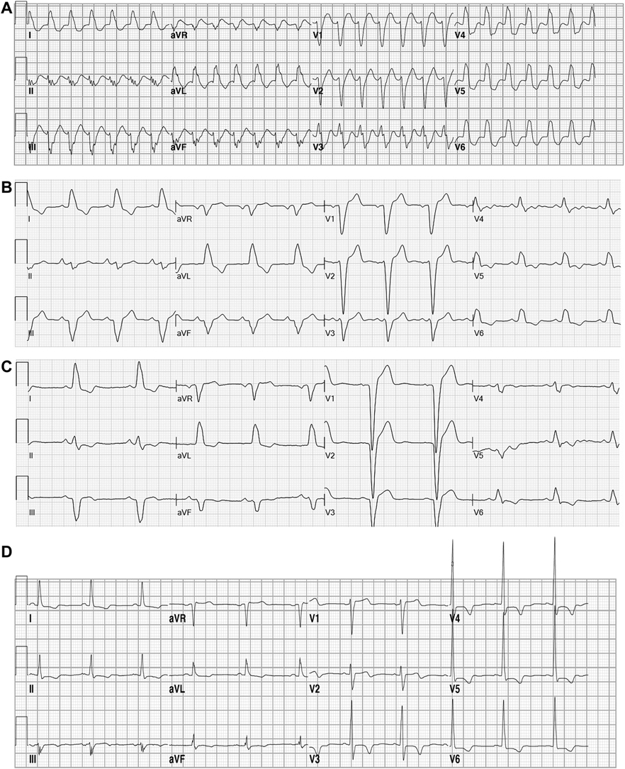 JACCJournals's tweet photo. @Alex_RaymondP #JACCCaseReports #WednesdayAnswer: Aberrant conduction is caused by 4 distinct EP mechanisms: phase 3 block, acceleration-dependent block, phase 4 block, & concealed transseptal conduction. This case offers a unique opportunity to review all in 1⃣ patient. https://t.co/PK3NUigvt7 https://t.co/RxG0bDBNHM