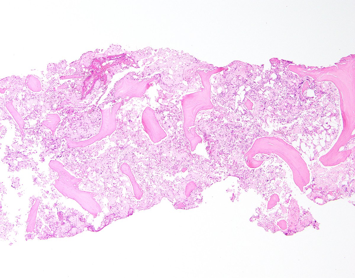 BWHPath's tweet photo. Time for our next #BWHPathCotW. What do you think of this bone marrow biopsy from an older man? #HemePath
1/ https://t.co/TMp3dS6yhv