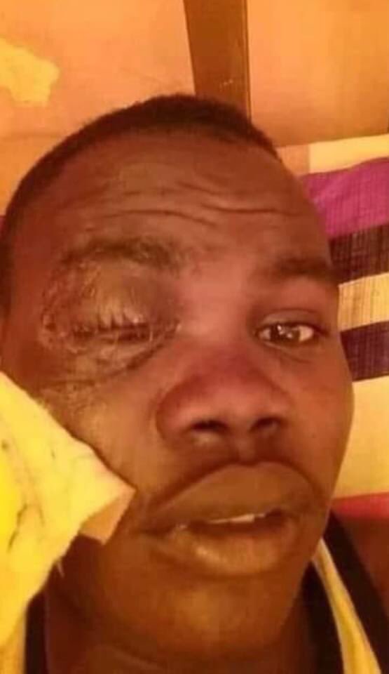 Nmhali's tweet photo. 9) Mujahid from Al-Kalakla lost an eye during #SudanCoup forces crackdown on #Nov30March protesters. He was hit by a tear gas canister.
He has a prosthetic eye now (left photo) 

#KeepEyesOnSudan 

https://t.co/b4P8Q7Niq9 https://t.co/yfcWV9XRLv