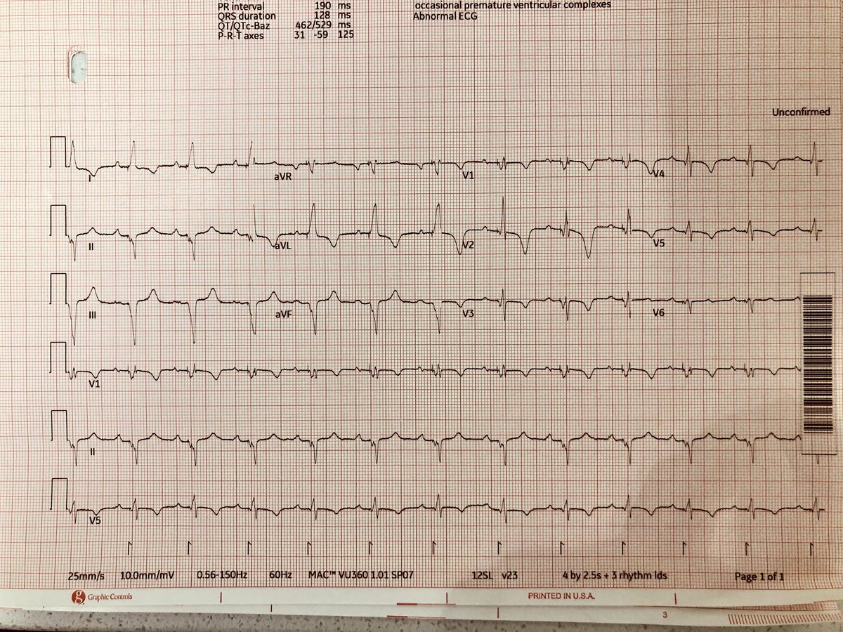 DrMRast's tweet photo. Loving the stylet driven lbb area pacing #epeeps ⁦@BIOTRONIK_US⁩ https://t.co/jEDMXe84O8