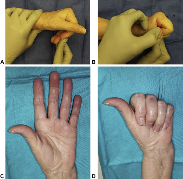 CNHC_research's tweet photo. In this newly published article, we investigated closed passive manipulation as an alternative to surgery for certain proximal interphalangeal (PIP) joint extension contractures. #passivemanipulation #PIPjointextension #contractures #proximal #joint
https://t.co/wcG4C29CrQ https://t.co/M31caxhHX5