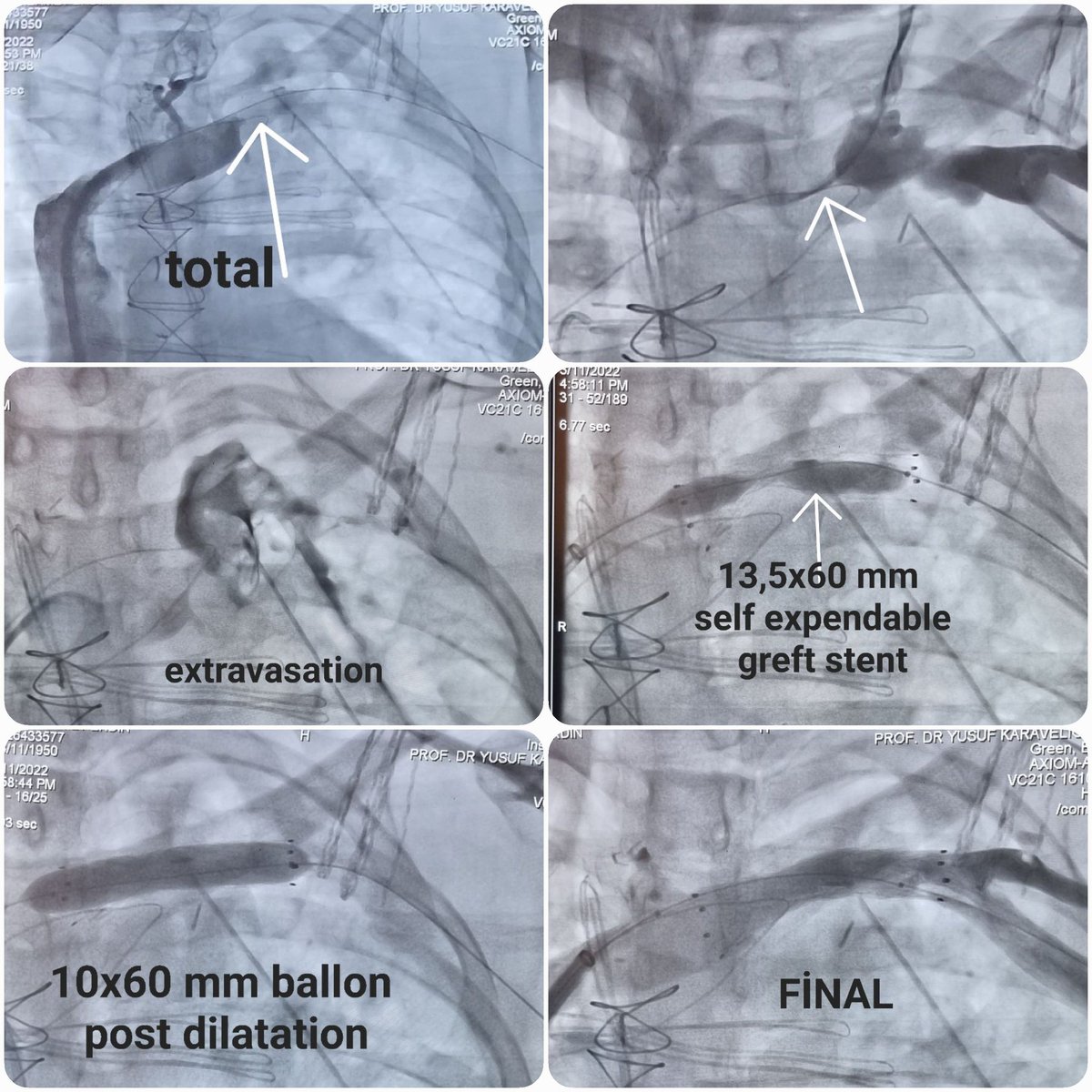 Subclavian vein (SV) injury after thymoma op. Despite SV surgical suturation, extravasated and total occluded.  SV was passed through the femoral +brachial vein with a 0.35 wire. A 13.5x60 mm self-expanded graft stent was successfully implanted. Less invasive, best invasive.