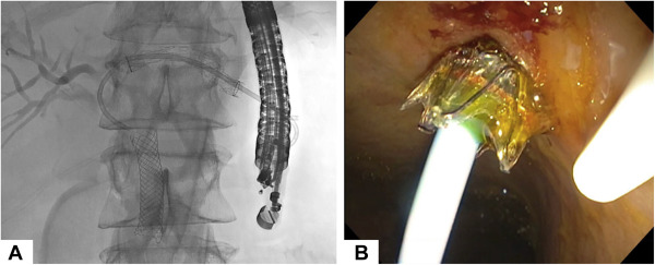 GIE (@gie_journal) on Twitter photo Hathorn et al detail a large single-center U.S. experience in "EUS-guided transhepatic biliary drainage." giejournal.org/article/S0016-…
<a href="/EndoTx/">Todd H Baron MD, MASGE</a> Hathorn et al detail a large single-center U.S. experience in "EUS-guided transhepatic biliary drainage." giejournal.org/article/S0016-…
<a href="/EndoTx/">Todd H Baron MD, MASGE</a>