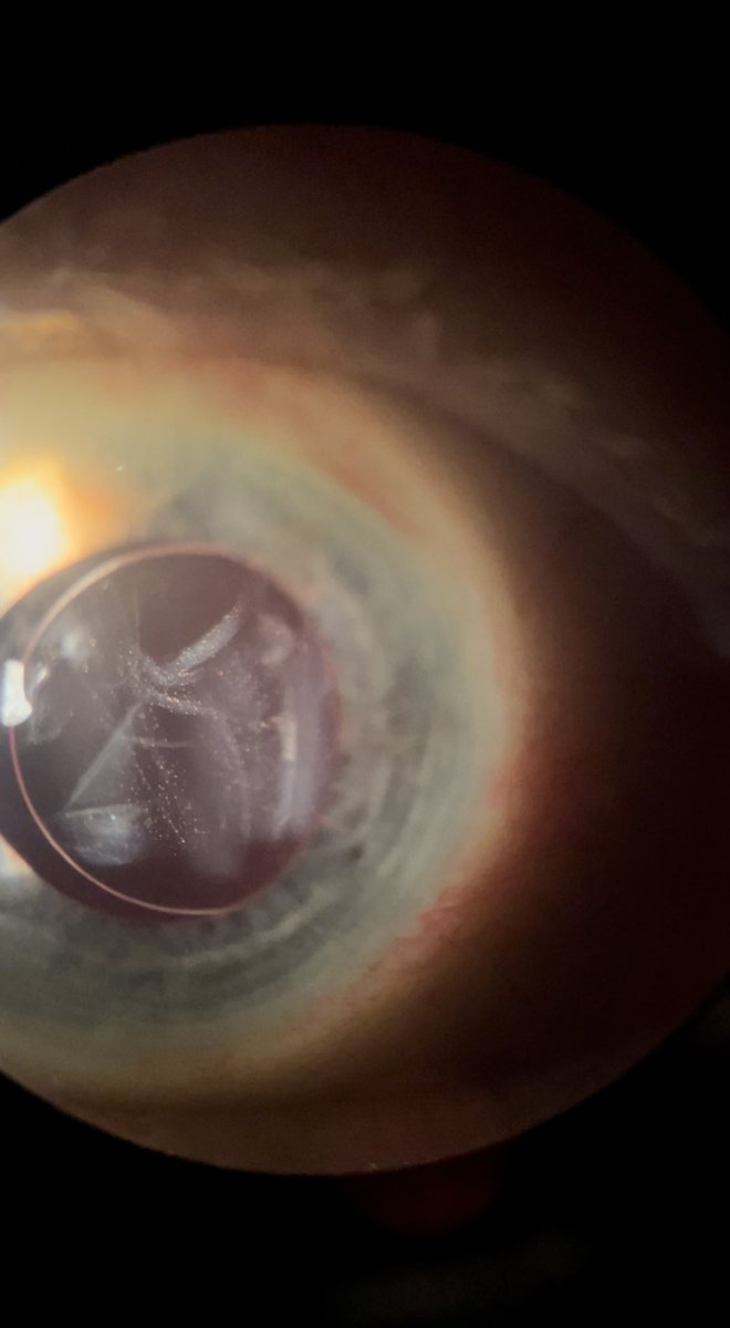tobacco dust in anterior vitreous Heed🚦the Shafer's sign! This 🔎 sign reflects pigmented cells in the anterior  vitreous, with the classic appearance of 🚬“tobacco dust.”Retinal tears and  detachments are 52% more likely if positive! 👀 #eyes #ophthalmology #