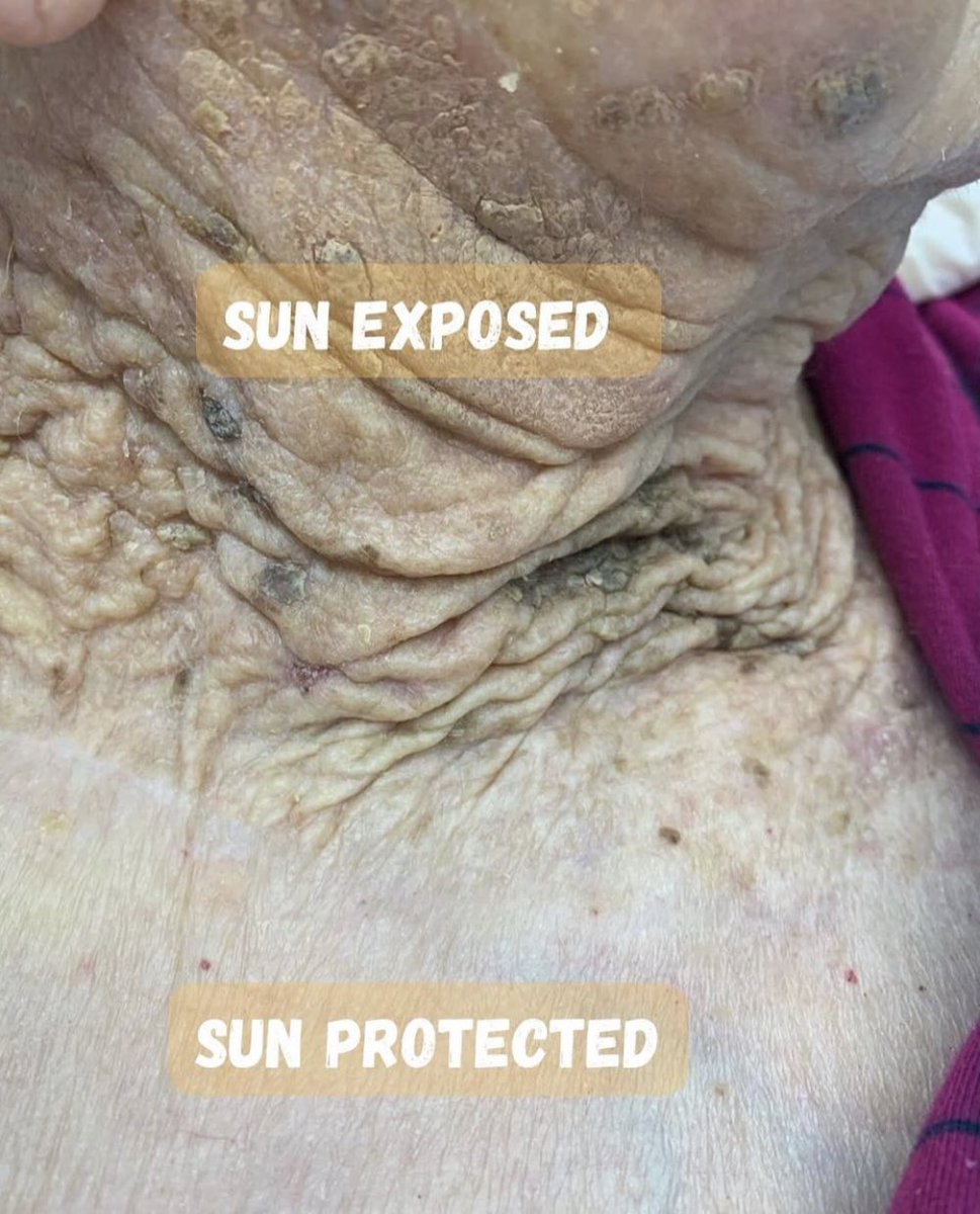 Living proof of the effects sun has on your skin, just incase you needed another reminder to apply sunscreen today! ☀️