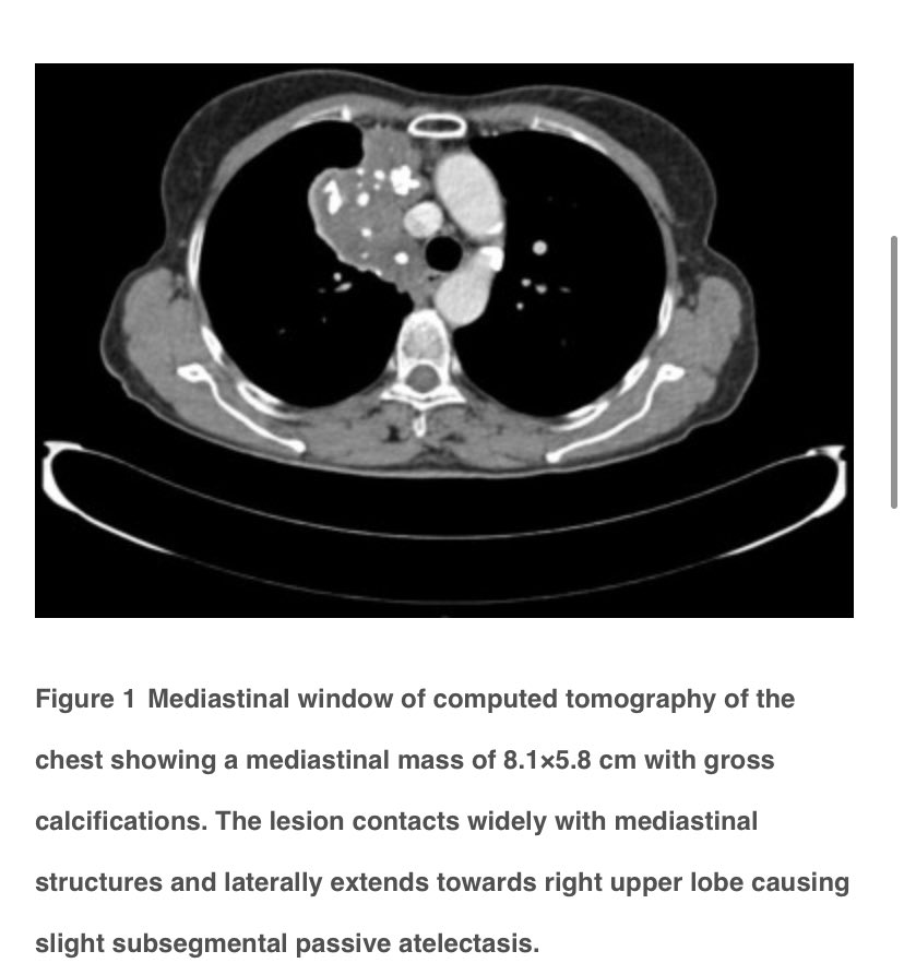 SurgJournal's tweet photo. Mediastinal mass with gross calcifications

@Acabanero @Usuecaballero @nicomoreno241 
@me4_so @Cirbosque @some4mv 

 https://t.co/Rj7pNsOVvm https://t.co/wj5dNNAnrR