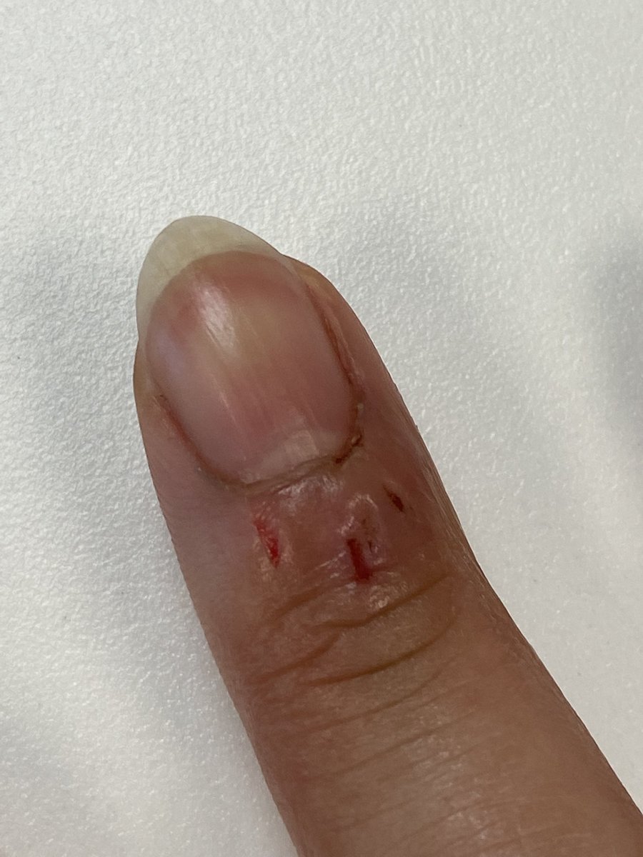 grlalyssa's tweet photo. Kinda fixed it by scratching off the dry skin and putting on lotion period https://t.co/kiq41WA28G