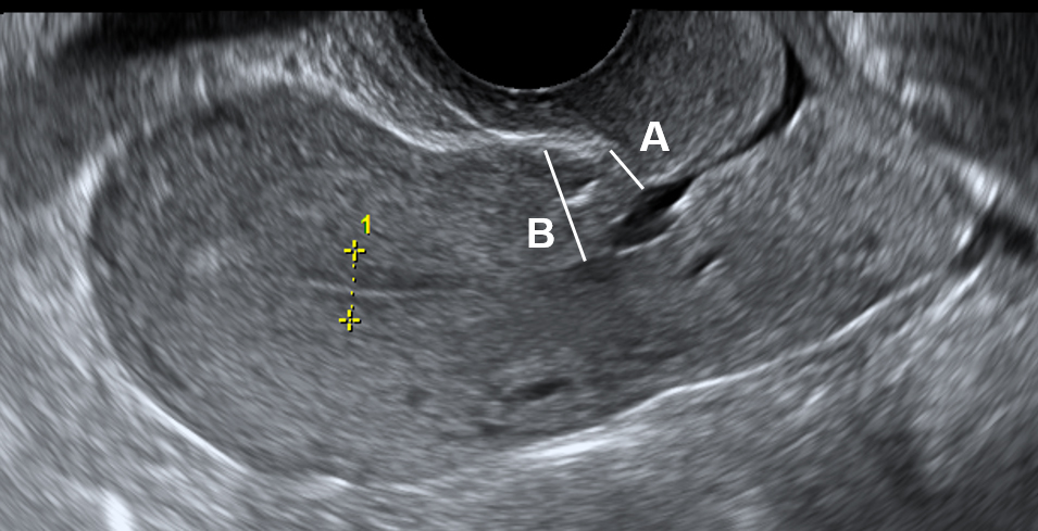 CEOGjournal's tweet photo. New publication
Safety and efficacy of knotless barbed suture in cesarean section using postpartum ultrasound: a retrospective cohort study
#postpartum_ultrasound #Knotless_barbed_suture
#Cesarean_section #Uterine_closure_time
#Ultrasound
https://t.co/vLnJpARbdK https://t.co/PMq3kXC1hi