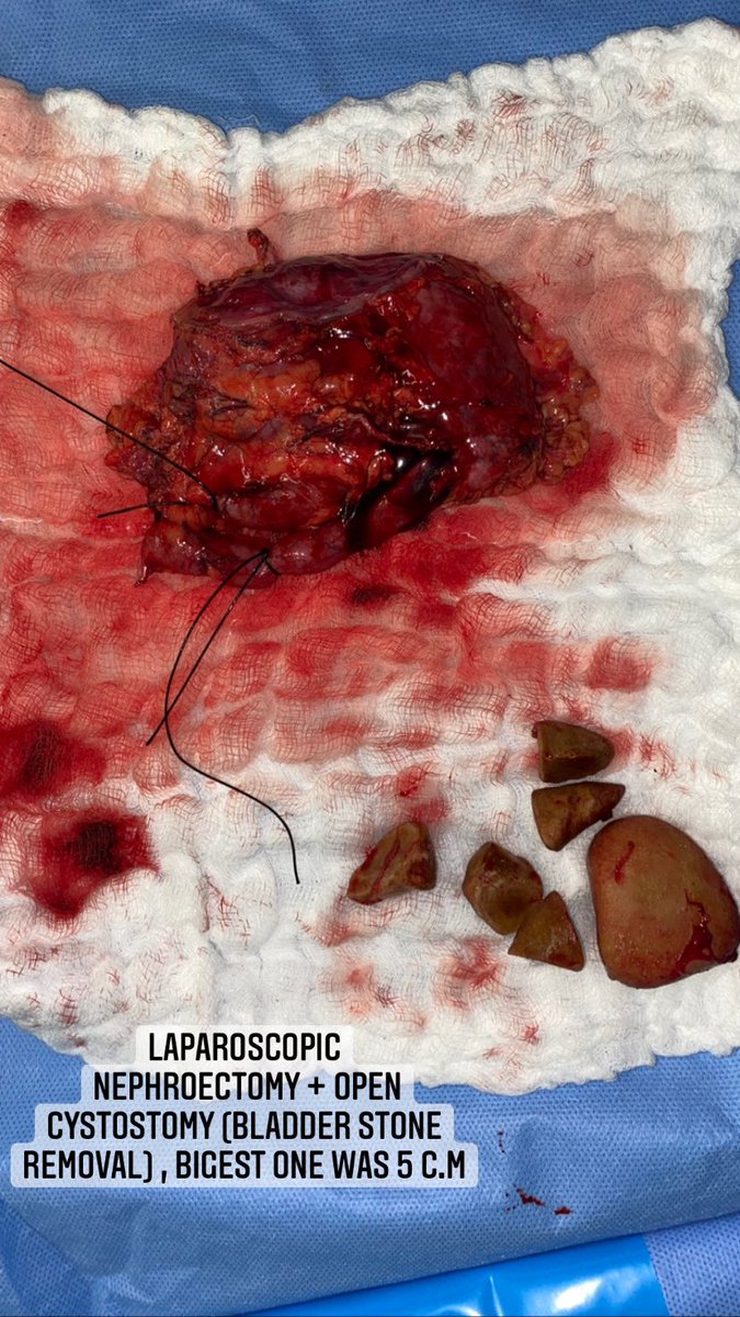 fahaad_a12's tweet photo. This is a 17+ years old male , come to ER complain of right flank and periumbilical pain .

#urology https://t.co/bkR00wtuvG