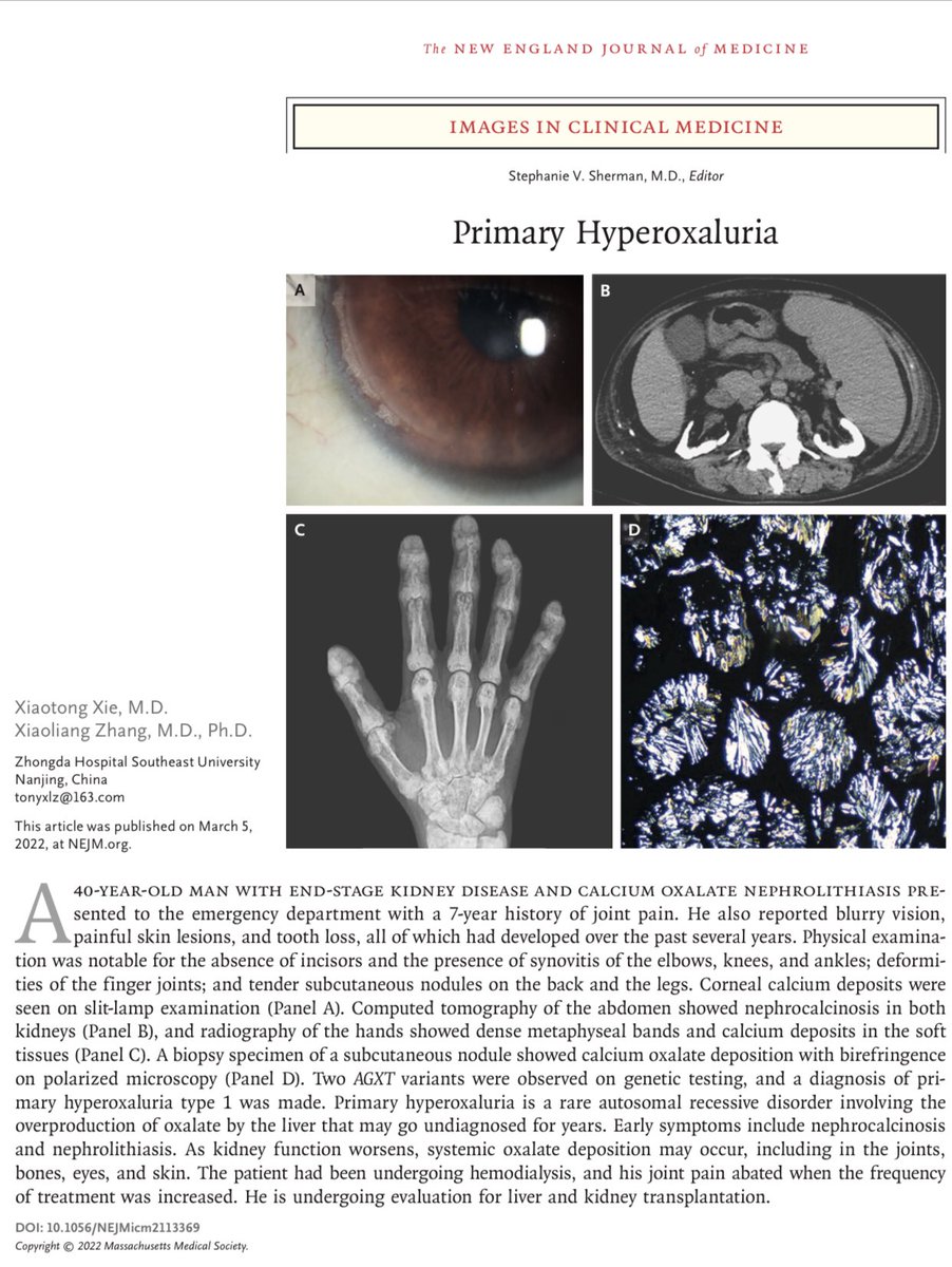 AmbrizMau's tweet photo. Hiperoxaluria primaria.

NEJM 2022; DOI: 10.1056/NEJMicm2113369 https://t.co/0DdQWwqorH