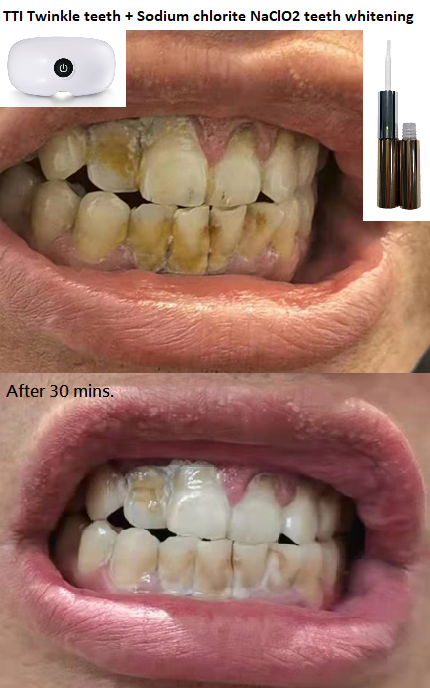 ttitwinkleteeth's tweet photo. TTI Twinkle Teeth can also enhance the brightening effect of sodium chlorite gel!

#teethwhitening #teethbleaching #teethwhiteningkit #teethwhiting #whitening #teeth #tooth #bleaching #dental  #toothbleach #cosmetic #aesthetic #dentistry #salon #sodiumchlorite https://t.co/jJ6POwMKpu