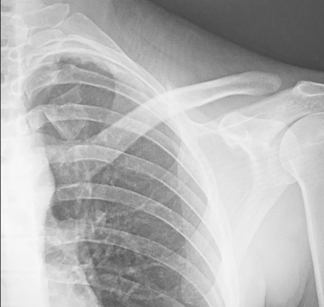 jbjs's tweet photo. Updated #JBJSClinicalSummary on #Clavicle #Fractures by Marc Swiontkowski, MD @UMNOrthoSurg https://t.co/nGKr32Zeo8