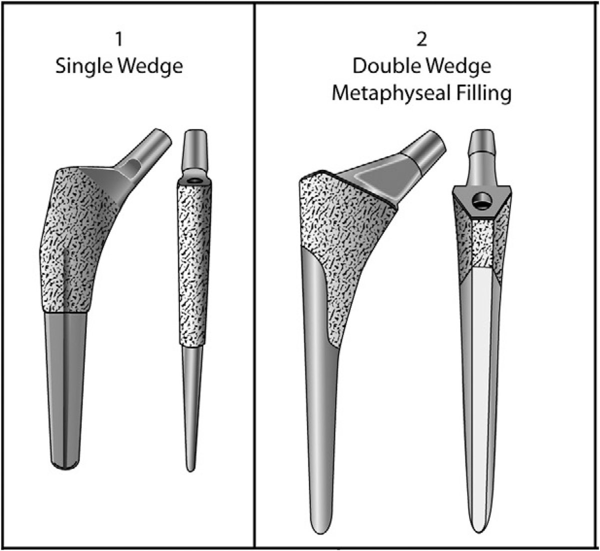 OfficialJAAOS's tweet photo. Does the stem matter for loosening after hemiarthroplasty? Find out from #JAAOS HERE: https://t.co/CGR06vz9aL #OrthoTwitter https://t.co/fsF2aiDF4S
