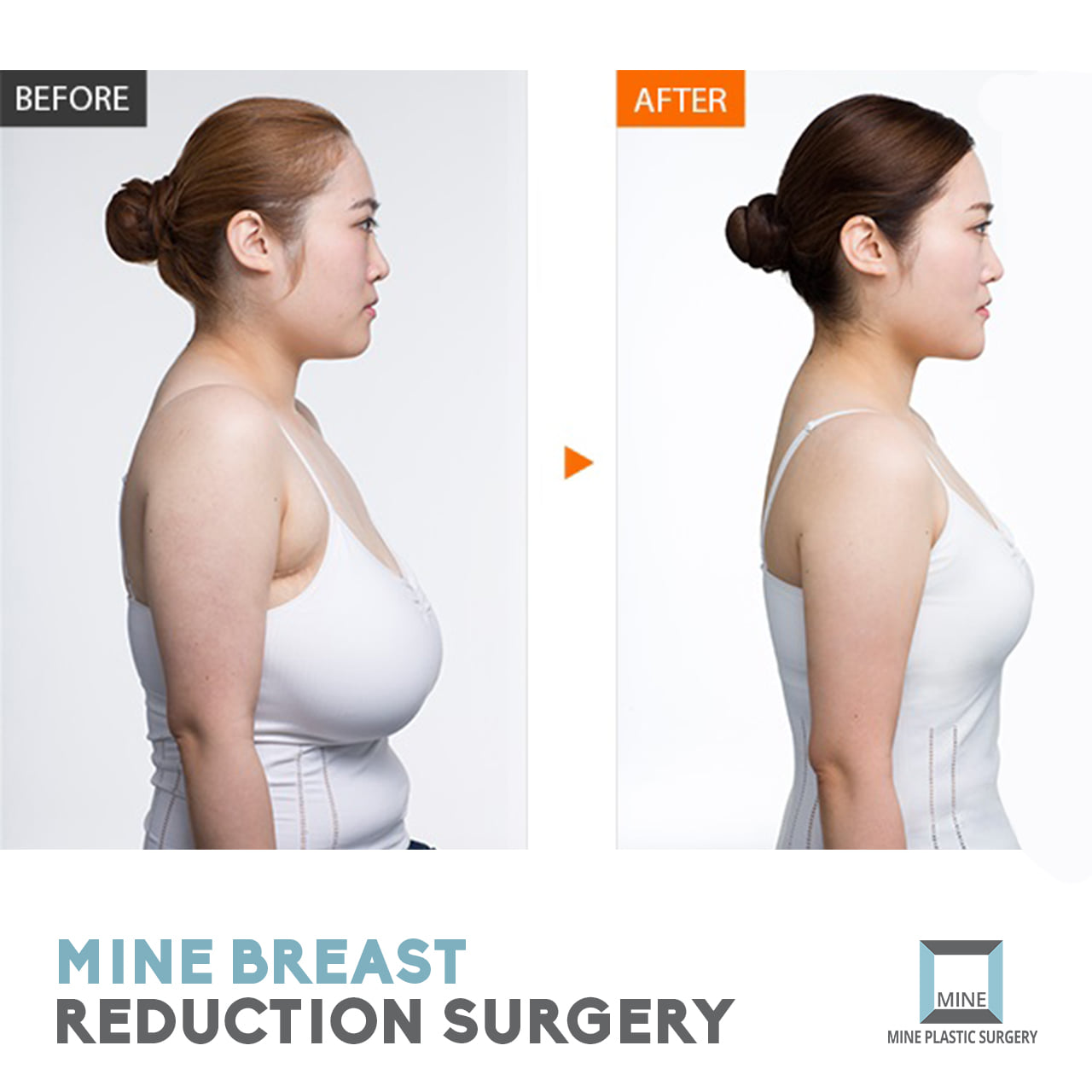 MINE Plastic Surgery on X: 'Breast Reduction Surgery' one of the