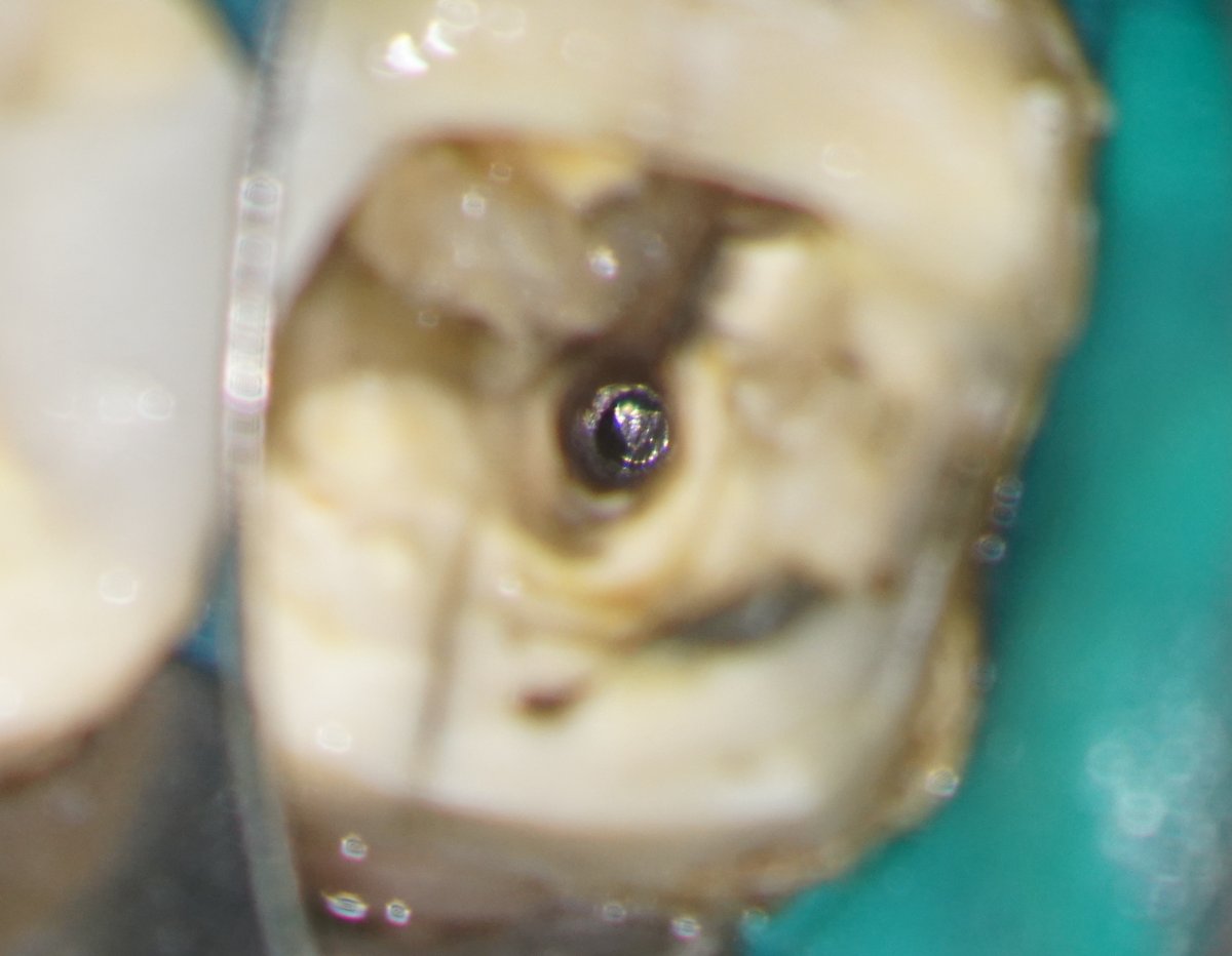 johnrhodesendo's tweet photo. External cervical resorption, deep margin management, fractured file removal and retreatment LR6 all in one case! 🙃 Existing crown used as temporary. Review in 6 months. @BetterEndo #savingteeth #endodontics https://t.co/uZBDqWbGFH