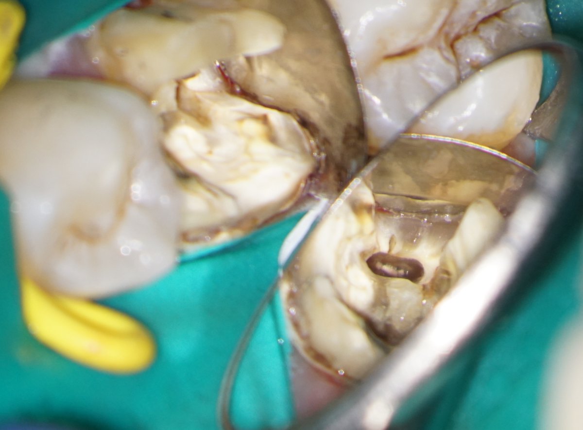 johnrhodesendo's tweet photo. External cervical resorption, deep margin management, fractured file removal and retreatment LR6 all in one case! 🙃 Existing crown used as temporary. Review in 6 months. @BetterEndo #savingteeth #endodontics https://t.co/uZBDqWbGFH