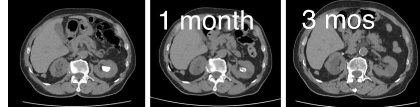 The best success 4 #endourologist:dissolving a big stone in 3 mos of alcalinisation in an octogenarian pt already scheduled for #PCNL elsewhere Always check HU on CT: all stones r white but below 500HU they r #uratic and dissolution is possibile &amp; must b attempted before surgery!