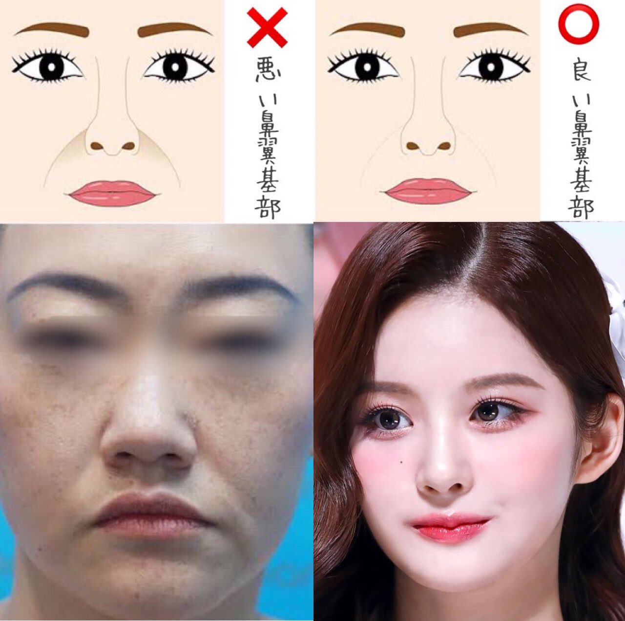 O Xrhsths 二重整形の病院選び 目頭切開 眉下切開 埋没法 グラマラスライン 全切開 眼瞼下垂 目尻切開の失敗 Sto Twitter 良い鼻翼基部と悪い鼻翼基部の違い 左側の鼻翼基部が陥没したパターンでは法令線がくっきりと出て横顔も写りが悪くなる これは鼻が