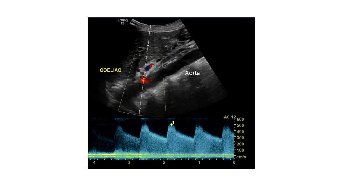 NBTPhysSci's tweet photo. By measuring the velocity of the blood flow in the artery we can demonstrate significant narrowing. Image of the coeliac artery stenosis (>500cm/s) #HCSWeek2022 #VascularScience https://t.co/SA74AeEug6