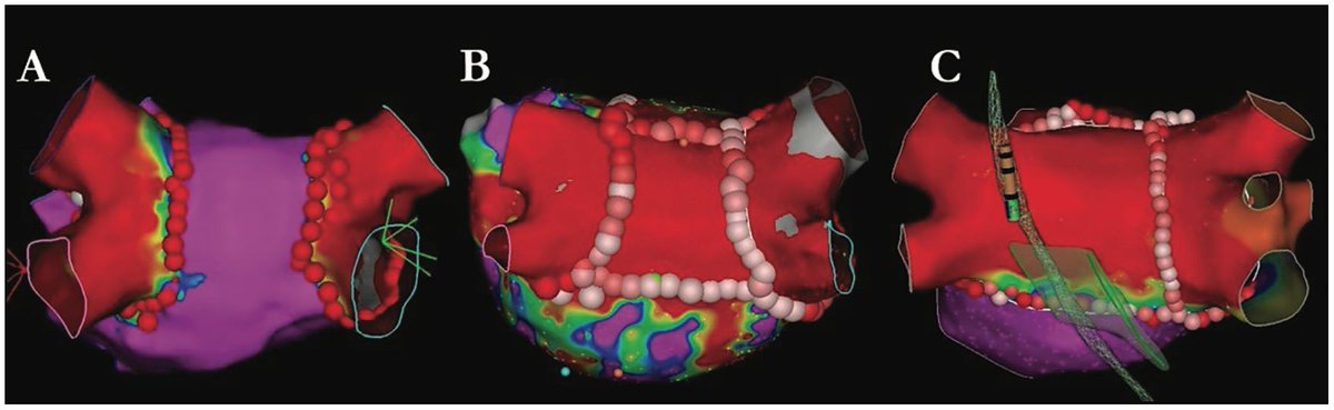 EP Lab Digest (@eplabdigest) on Twitter photo The Comprehensive Approach to Atrial Fibrillation Management at Beth Israel Deaconess Medical Center <a href="/ZimetbaumP/">Peter Zimetbaum, MD</a> #EPeepsĀ #AFĀ
okt.to/bupkm3 The Comprehensive Approach to Atrial Fibrillation Management at Beth Israel Deaconess Medical Center <a href="/ZimetbaumP/">Peter Zimetbaum, MD</a> #EPeepsĀ #AFĀ
okt.to/bupkm3