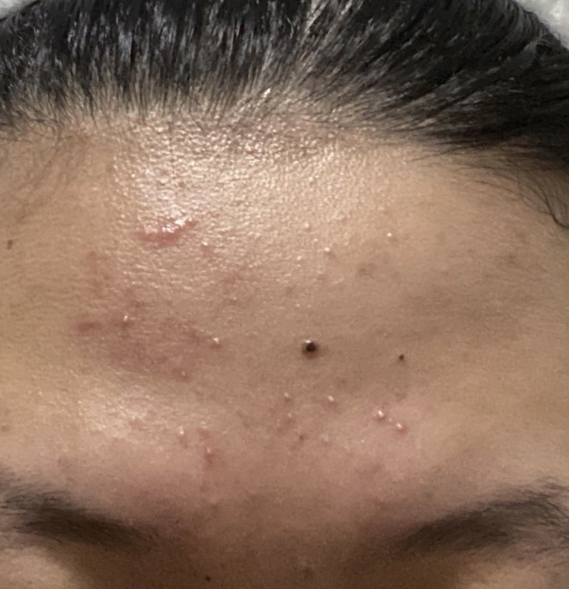 sukaskincarean's tweet photo. Tips mengurangi bruntusan ✨

a thread https://t.co/uHH7ET4XpI