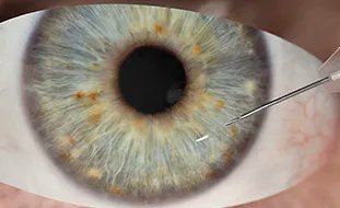 Glaucoma Physician on Twitter: