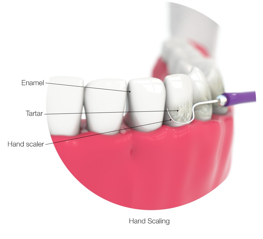 archerdentalca's tweet photo. New Graphic - #HygieneTherapy Consider spring #TeethCleaning to get your smile refreshed for outdoor weather. Dental hygienists at Archer Dental use #handscalers and #powerscalers to remove tartar from tooth enamel. https://t.co/BRgWj4GKLD https://t.co/kpd76qFWsX